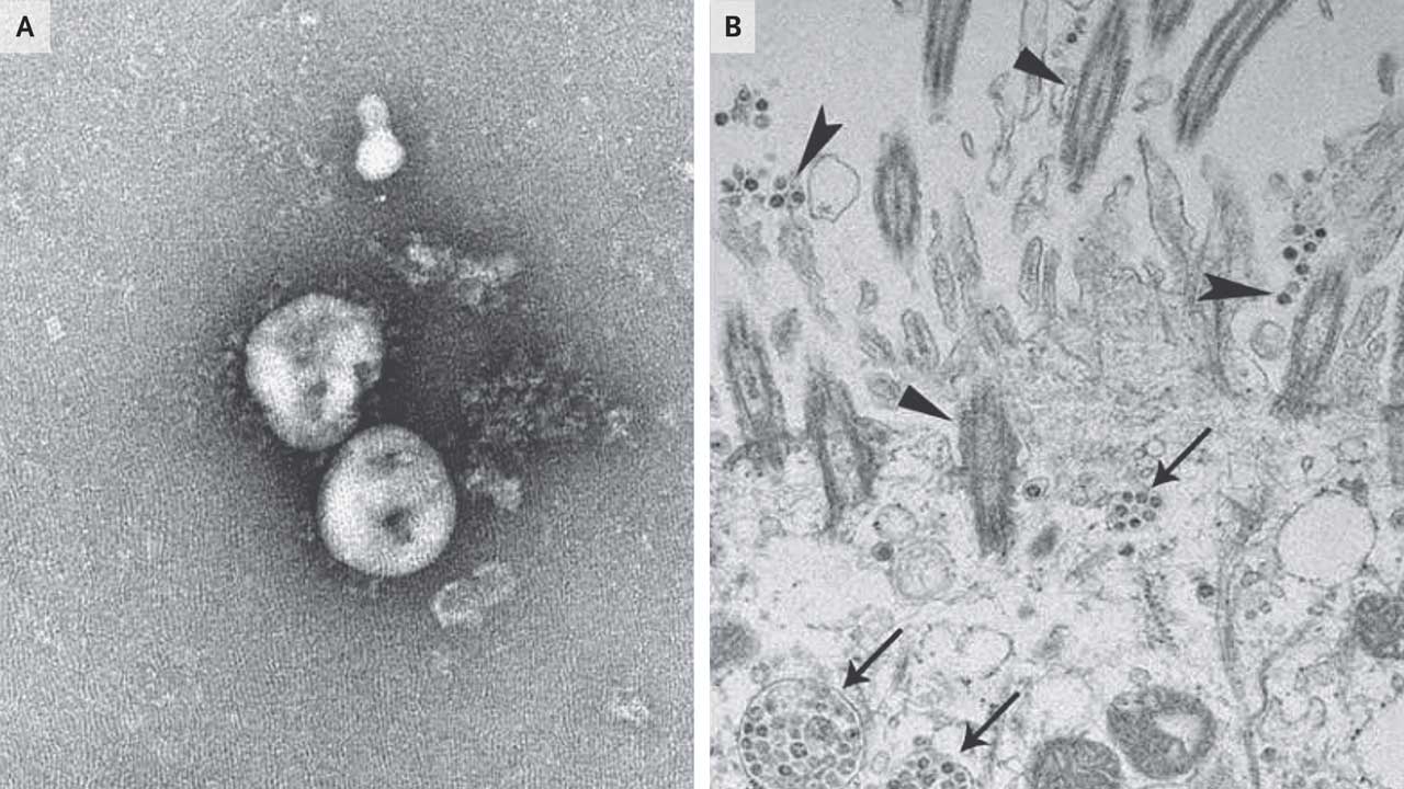 Electron miscroscopy images of SARS-CoV-2 virions from Na Zh et al., New England Journal of Medicine, February 2020.